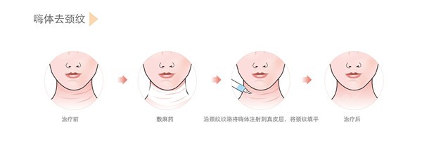 嗨体去颈纹操作步骤8682.cc