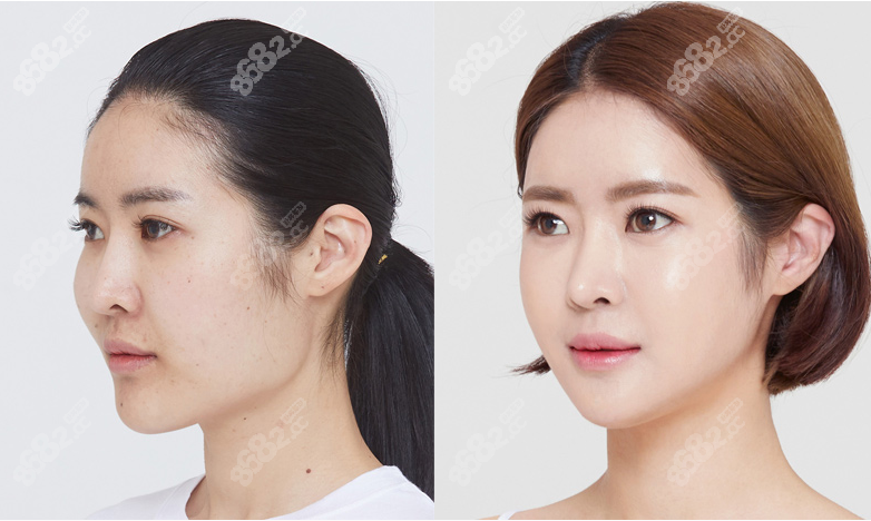 韩国伊美芝医院颧骨下颌角磨骨图片:她做轮廓后大脸变小脸,颌面对比照