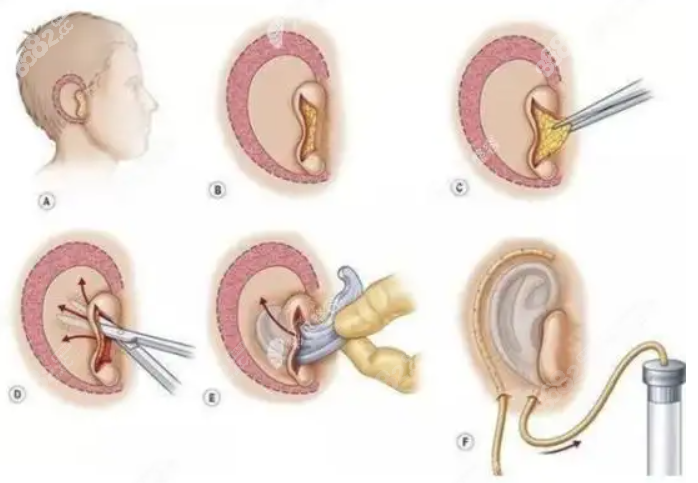 耳再造手术过程图示