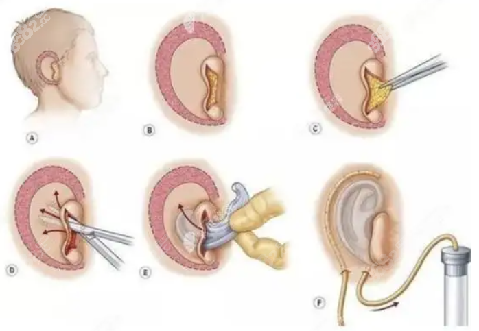 整形外科,有30多年的耳再造手术经验,做过的耳再造手术成功道浅６