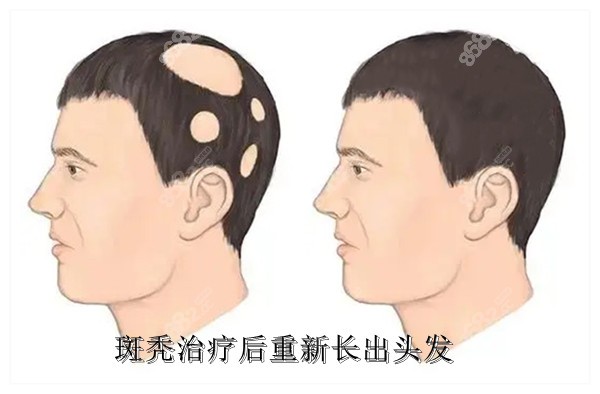 斑秃十几年了还可以治疗好吗