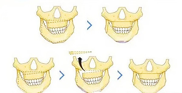 大正颌手术的原理图www.8682.cc