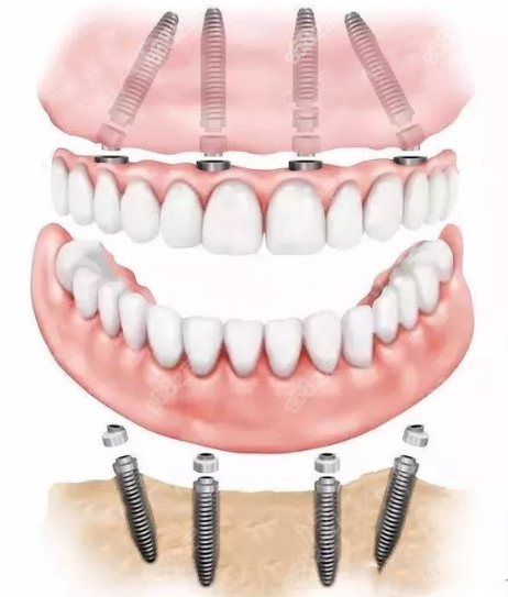 国产康盛种植牙5k ,进口奥齿泰种植牙6k ,种植牙-8682赴韩整形网