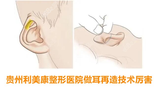 贵州利美康医院耳再造技术怎么样