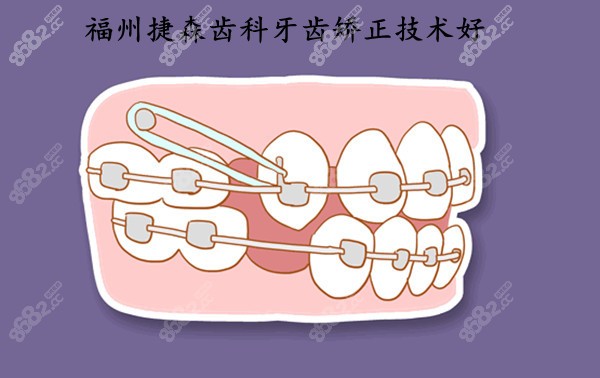 福州捷森齿科做牙齿矫正技术、口碑好8682.cc