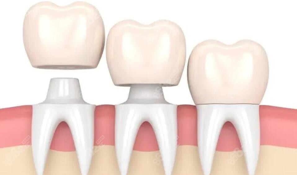 牙冠缺损太大，需要进行桩冠修复
