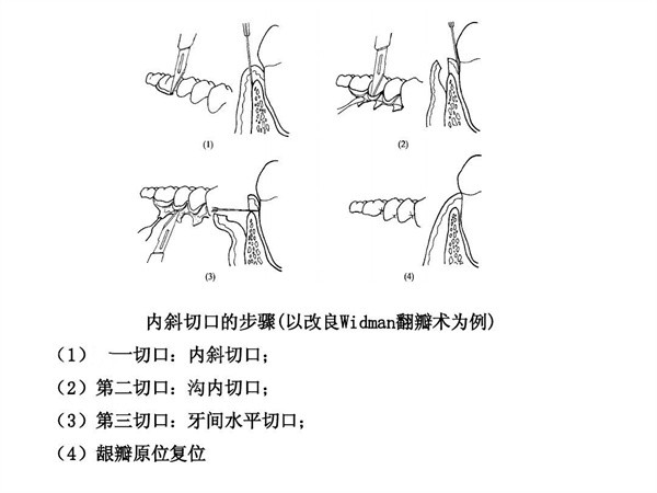 牙周翻瓣手术步骤