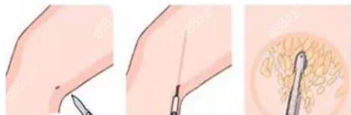 多维直腿术怎么做（m.8682.cc）