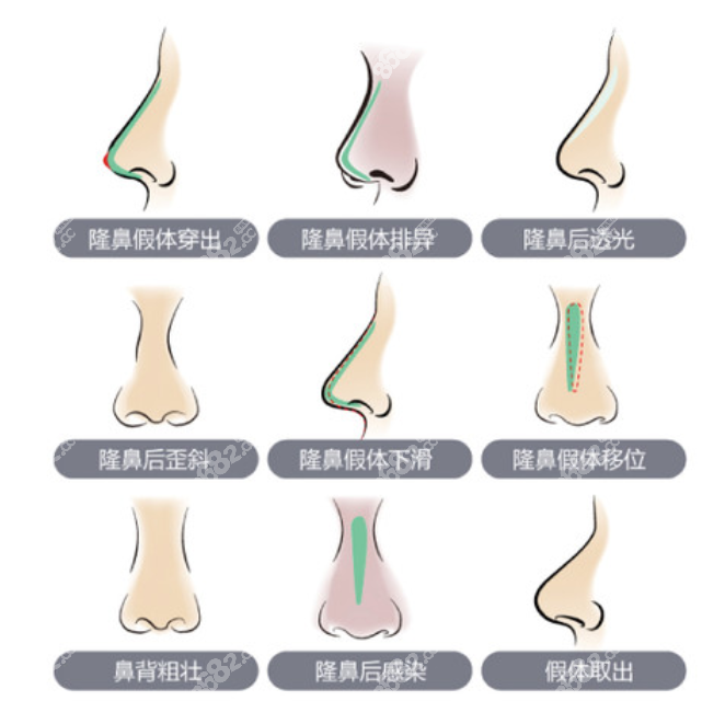 西安鼻修复类型