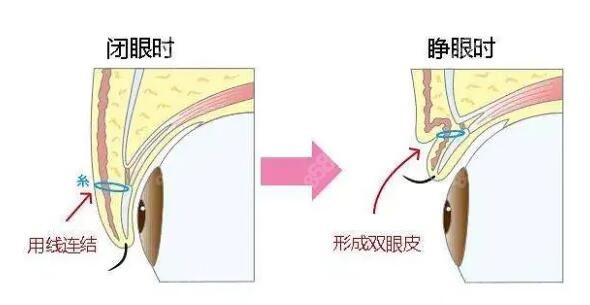 韩国眼综合出名的医生技术图