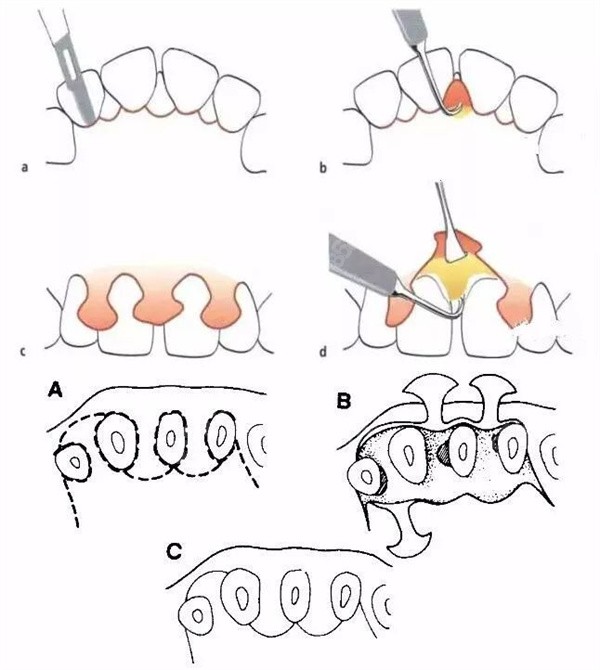 牙周翻瓣手术步骤