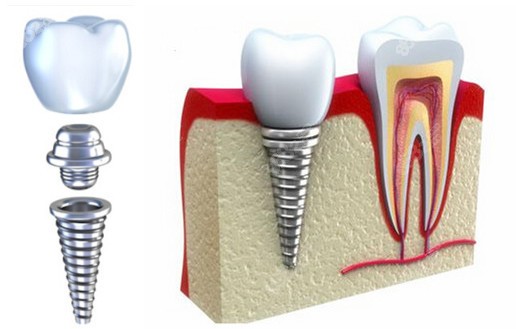 下牙缺失导致上牙长长的修复方法：种植牙