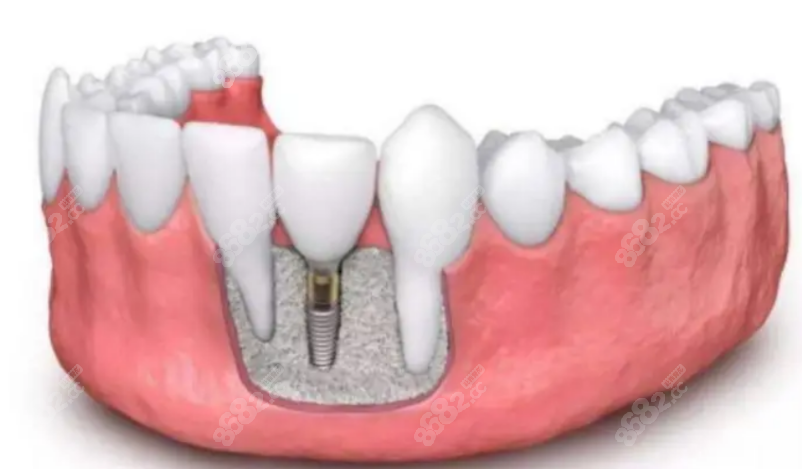 种植牙8682.cc