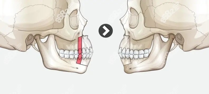 凸嘴正颌术前术后对比