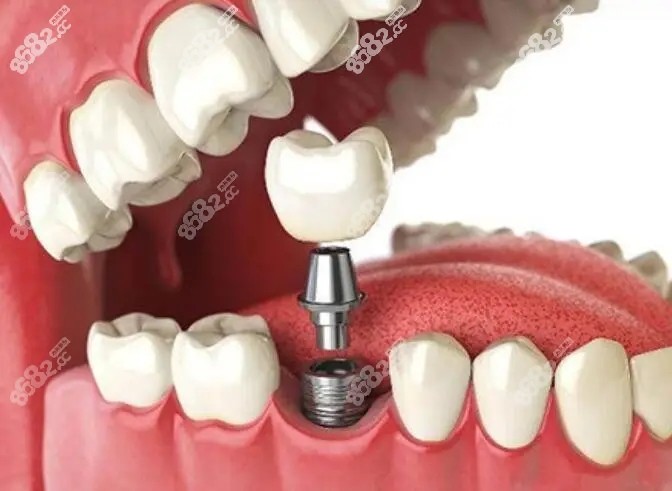 韩国种植牙价格低8682.cc