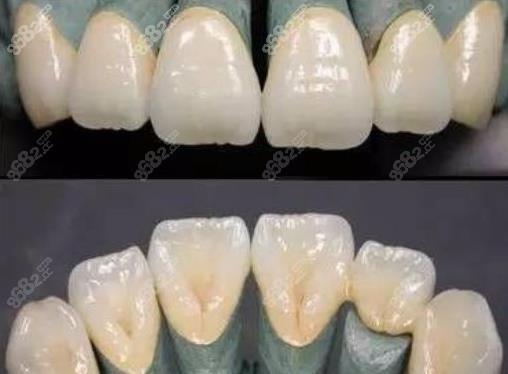 下牙缺失导致上牙长长的修复方法：截断牙齿