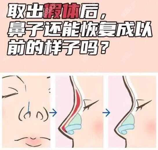 鼻子假体取出来后能恢复到以前吗