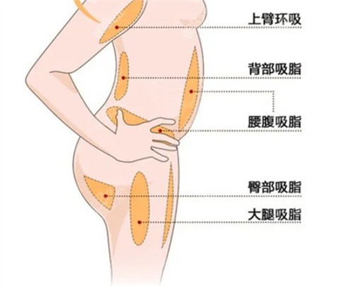 南京艺星吸脂哪个医生好？