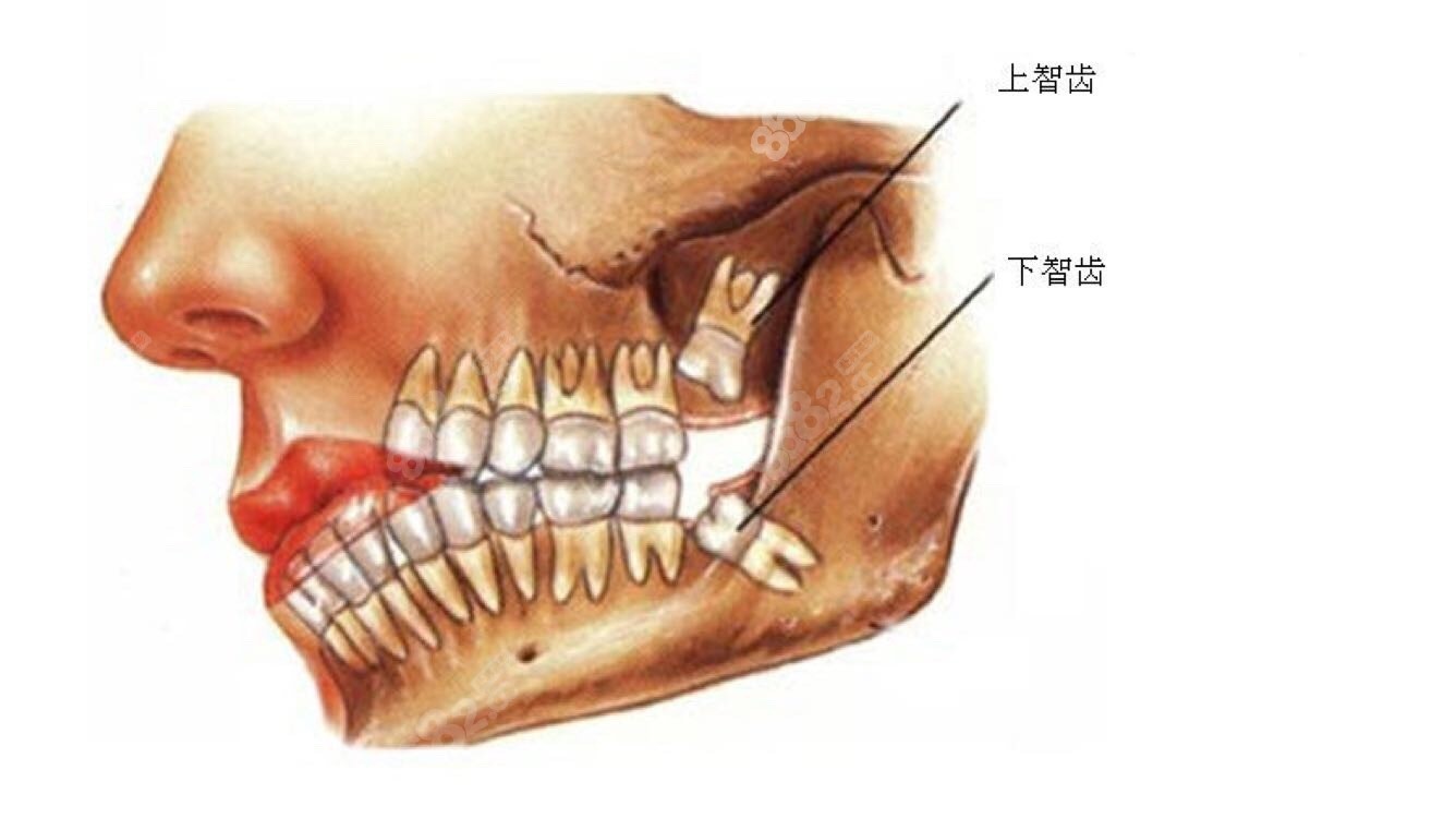 四颗智齿都拔有没有这个必要jpg