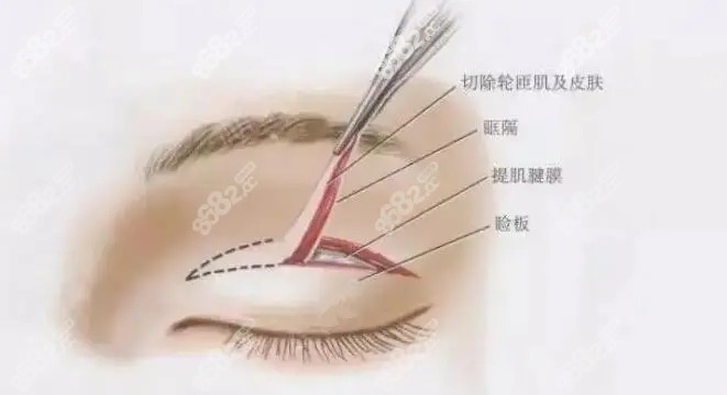 双眼皮手术细节