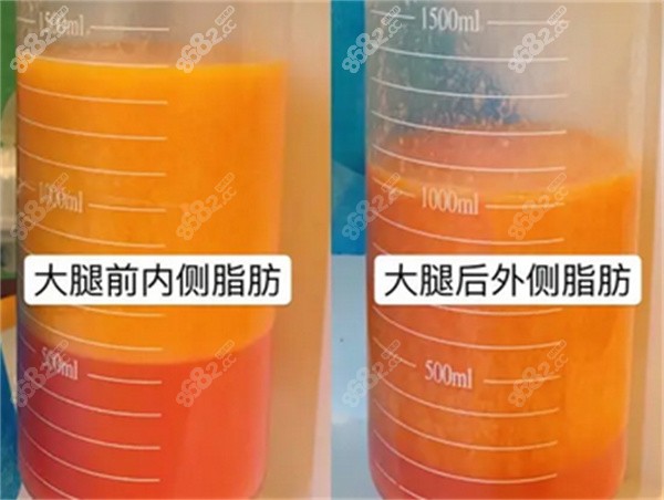 svf自体脂肪填充和普通自体脂肪填充区别在哪里