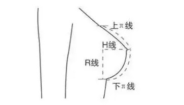 隆胸假体胸型好