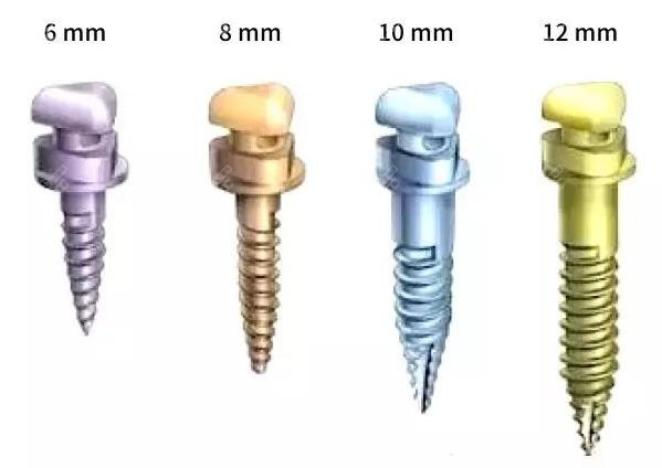 下牙缺失导致上牙长长的修复方法：支抗钉