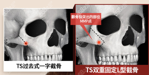 韩国ts做颧骨采用的是双重固定颧骨缩小术