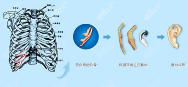 韩国做耳再造手术常见的技术www.8682.cc