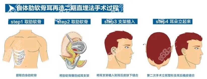 自体肋软骨全耳再造