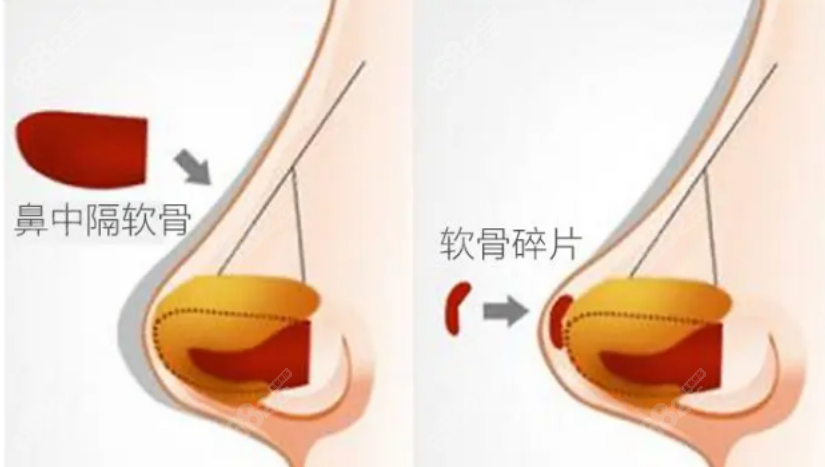 梁晓健医生隆鼻