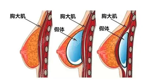 美国隆胸医生资质深厚