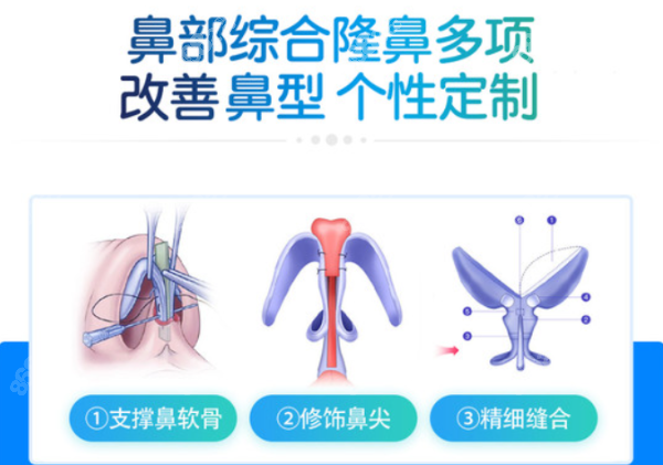 杭州清鍇汪云鋒醫(yī)生隆鼻技術(shù)好嗎