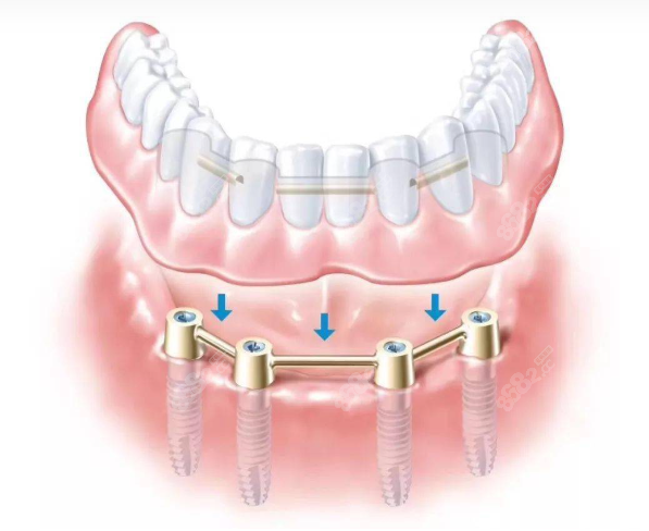 无锡维乐口腔半口种植牙价格表