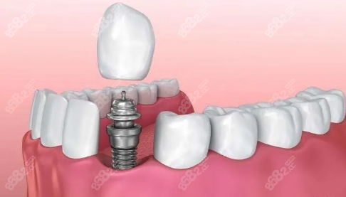 牙根（种植体）的价格8682网
