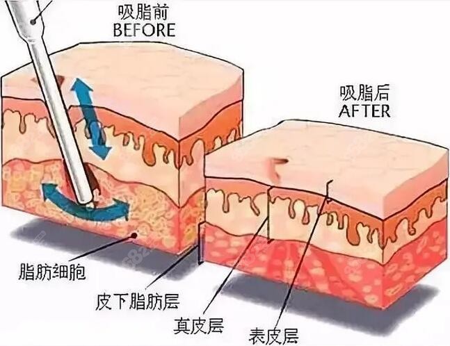 吸脂原理前后对比