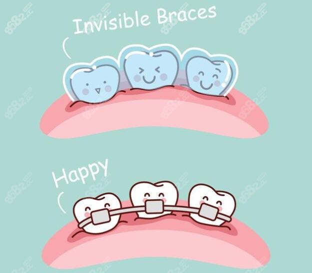 金属矫正和隐形矫正