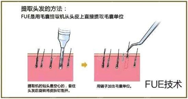 FUE植发技术
