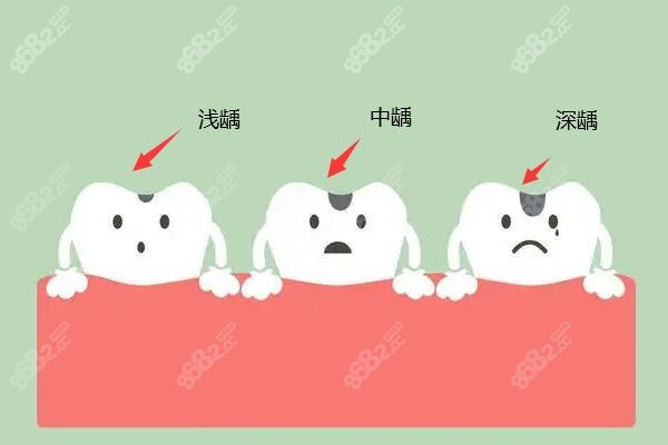 儿童浅龋、深龋补牙多少钱