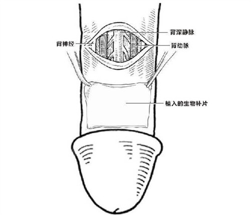 世檀塔男科医院做增大增粗怎么样？