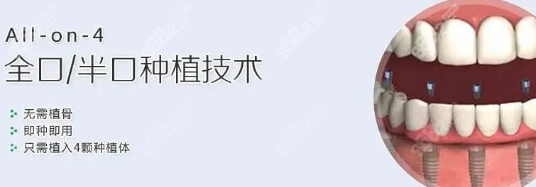 all-on-4种植