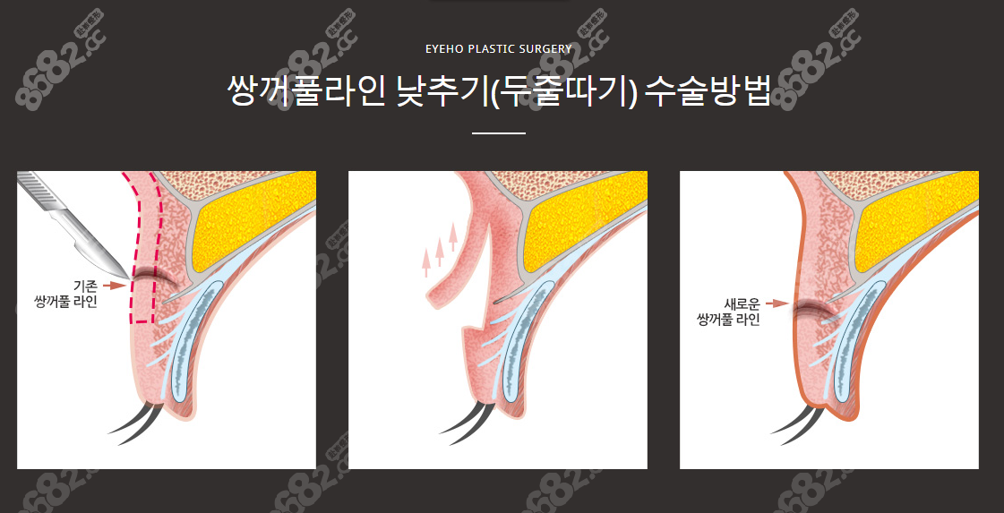 8682网分享韩国爱护整形外科眼修复手术特色