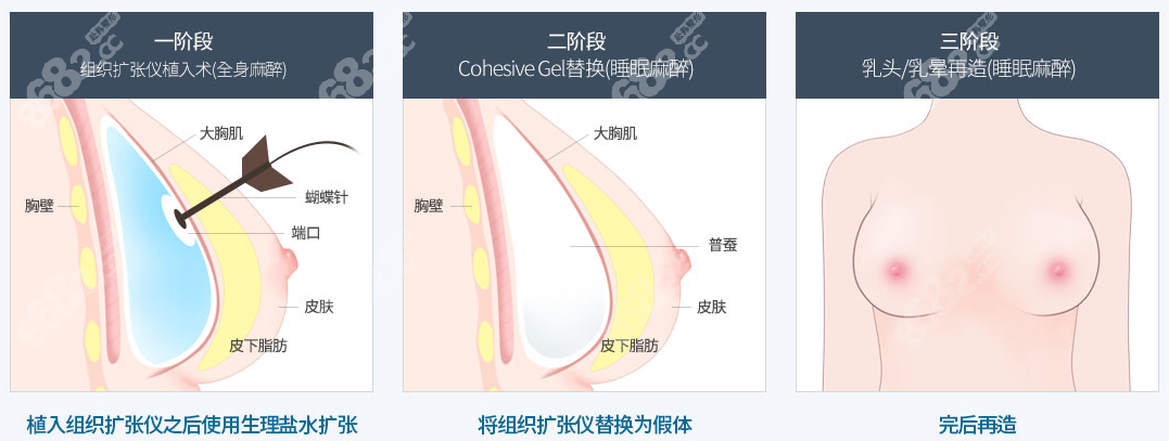 假体植入胸再造手术方法