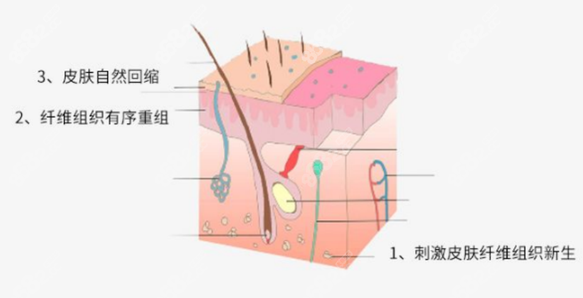 吸脂手术