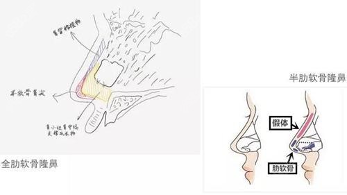 半肋骨鼻和全肋骨鼻的区别图