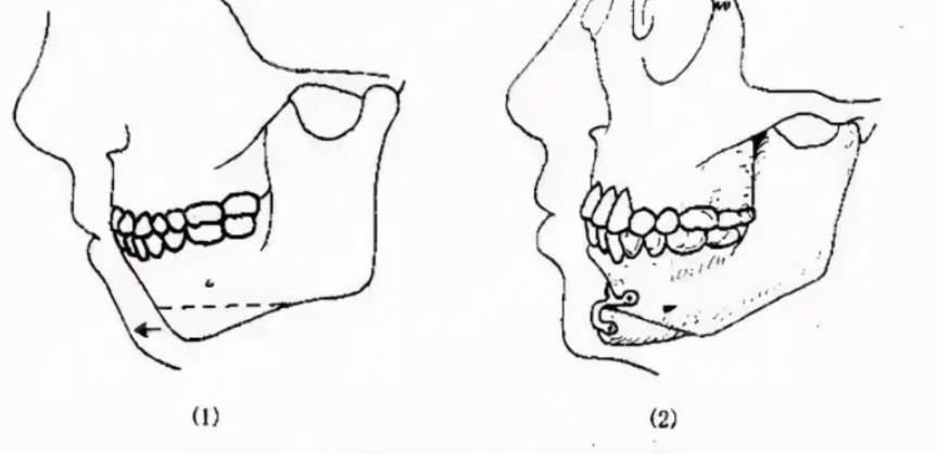 颏成型手术和正颌区别