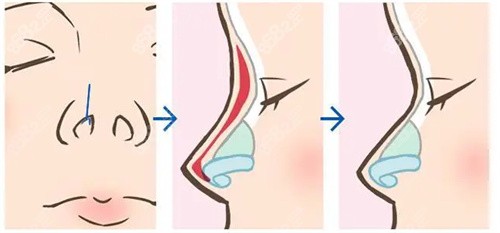 假体隆鼻可以有效改善塌鼻短鼻