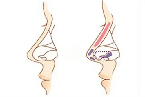 隆鼻前后形态对比