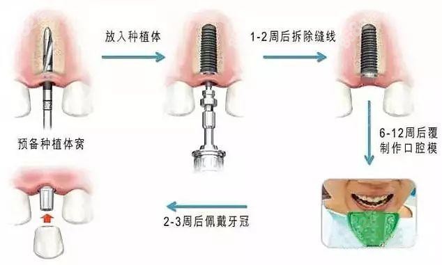 西宁华康口腔做种植牙的原理图