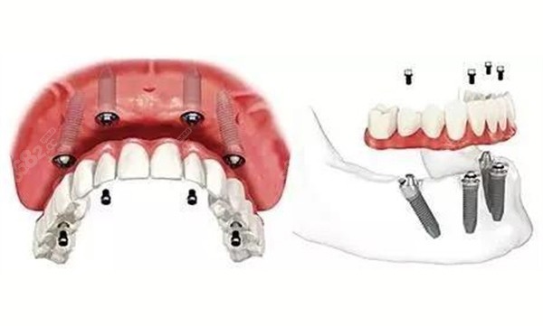 邯郸全口种牙多少钱